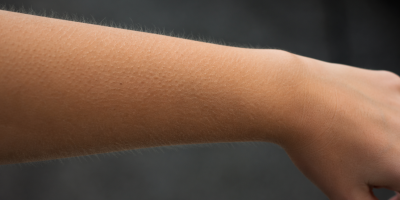 Dlaczego mamy gęsią skórkę, choć nie mamy futra